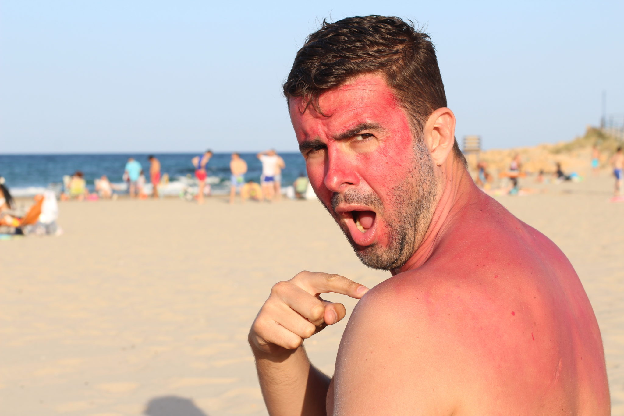 После солнца сильно. Обгорелые люди на пляже. Мужик обгорел на пляже.